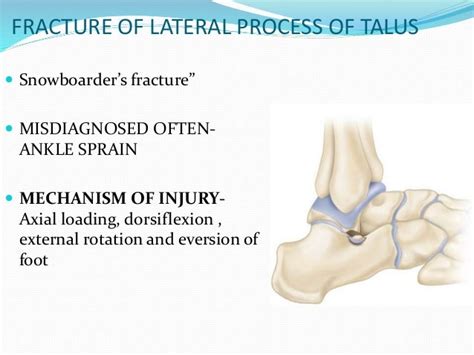 Talus Fracture Classification