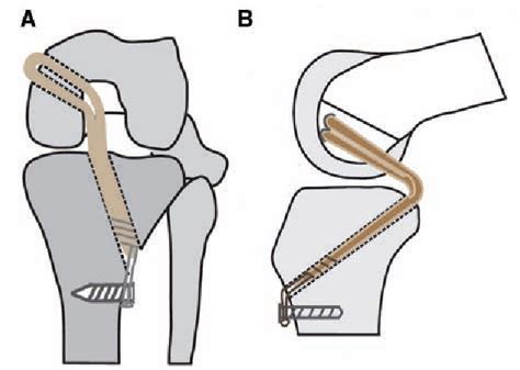 Figure 1 From Evaluation Of Transtibial Double Bundle Posterior Cruciate Ligament Reconstruction