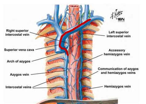 Learning Radiology - Central, Venous, Catheter, Azygos, Vein