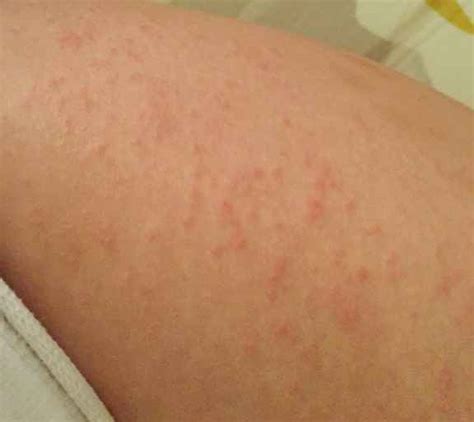 Itchy Bumps On Skin