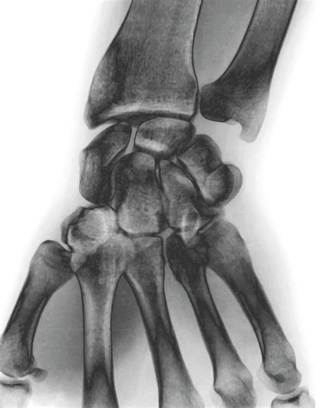 Normal Wrist X Ray By Zephyr