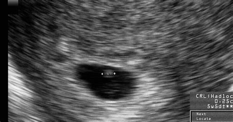 5 Weeks Ultrasound Scan All Your Questions Answered Mybump2baby 2023