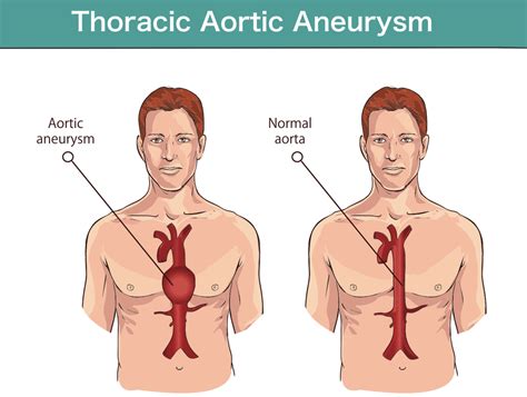 Aorta Artery Aneurysm