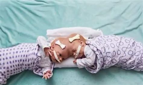 Conjoined Twins Remember These Twins Joined At The Head See Them Now After Surgery