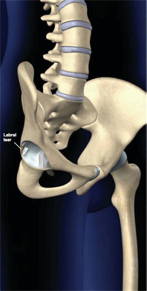 Labral Tears Of The Hip Central Coast Orthopedic Medical Group