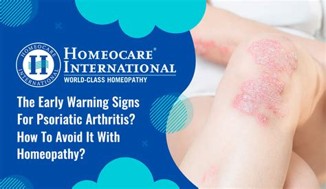 The Early Warning Signs For Psoriatic Arthritis