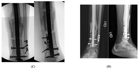 Medicina Free Full Text The Clamshell Osteotomy For Diaphyseal