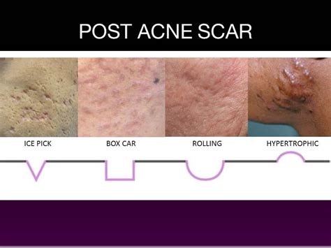 Say No To Scars With Hiruscar