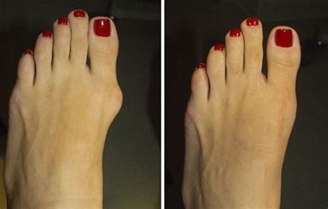 Bunion Surgery Rocky Hill Ct Newington Ct Middletown Ct