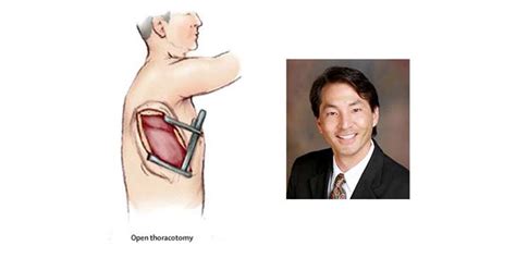 Novel Muscle Sparing Thoracotomy Improves Exposure Orthopedics This Week