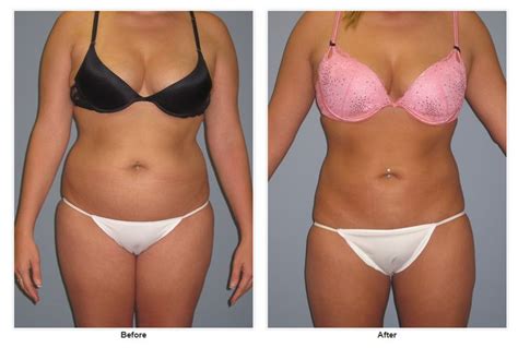 This Is A 29 Year Old Woman Who Underwent Power Assisted Liposuction Of