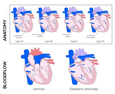Example of anomaly detection in a fetal interventricular septum using object detection technology. Ebstein Anomaly: Practice Essentials | Faculty of Medicine