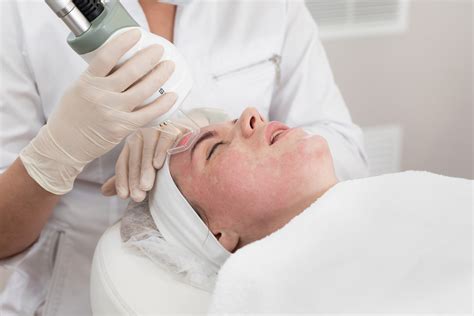 Dangers Of Chemical Peels Laser Skin Resurfacing And Filler