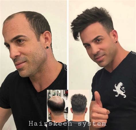 Hair Replacement For Men Non Surgical Hair Loss System