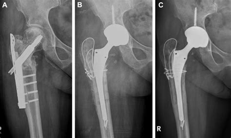 Conversion Hip Arthroplasty in Failed Fixation of ...