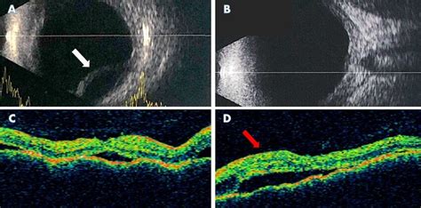 A B‐scan Ultrasound Of The Right Eye Showing An Inferior Serous