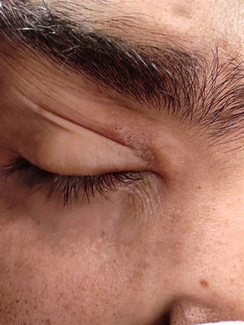 Blistery Skin Rashes Developed On The Right Upper Eyelid 2 Days After