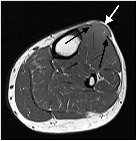 Tibialis Anterior Muscle Hernia A Rare Differential Of A Soft Tissue