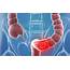 More Inherited Colon Cancer Risks Identified By New Genetic Test 