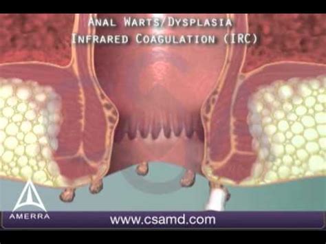 Anal Warts D Medical Animation Youtube