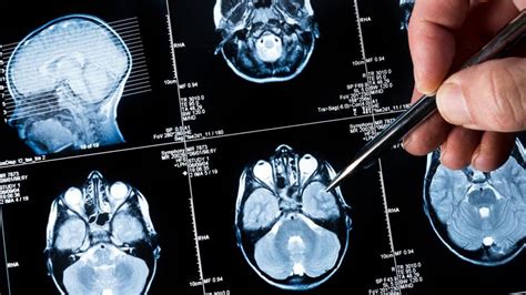 una punción lumbar mejora el diagnóstico del tumor cerebral más agresivo