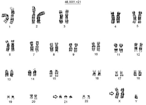 G Banding Karyotype Of The Patient With Double Aneuploidy 48xxy21