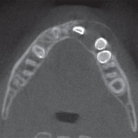 Pdf Inflammatory Dentigerous Cyst In A Ten Year Old Child