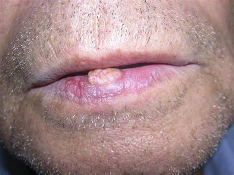 Squamous Cell Carcinoma Of The Lower Lip Journal Of Oral And