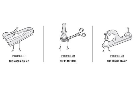Anatomy Of A Circumcision New York Magazine Nymag