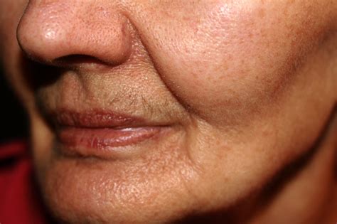 Nasolabial Wrinkled Fold On The Skin Of The Face Stock Photo Download