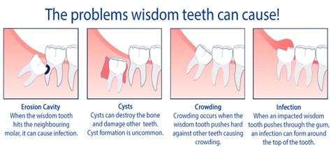 Possible Side Effects And Complications Wisdom Teeth Removal
