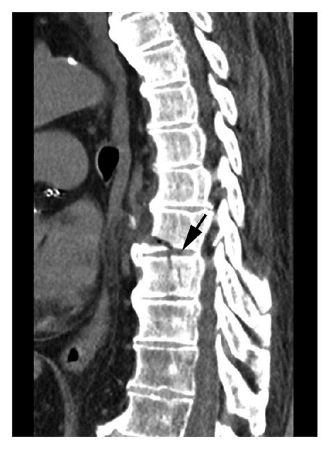 Sagittal Ct Scan Of The Thoracic Spine Showing An Oblique Fracture