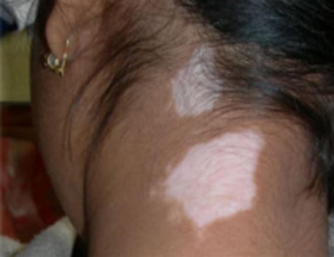 B12 Vitamin Deficiency White Patches On Face White Spots On Skin What