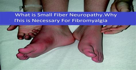 Small Fiber Neuropathy In Fibromyalgia And Cfs Fibromyalgia Resources