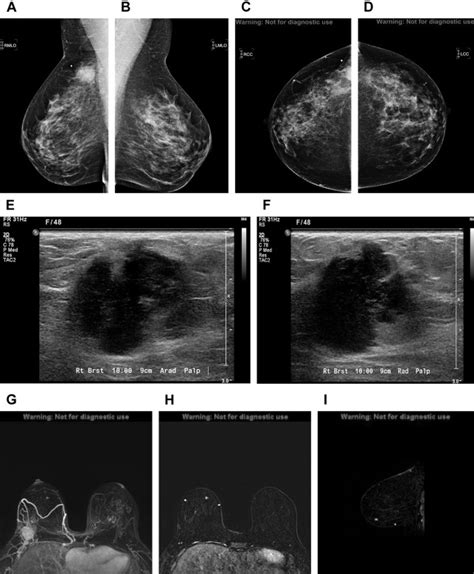 Breast Mr Imaging In Newly Diagnosed Breast Cancer Radiologic Clinics