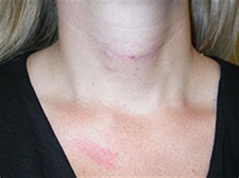 Scar Tissue After Thyroid Surgery