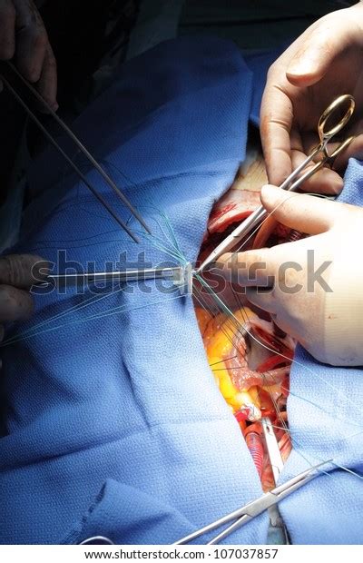 Cardiac Surgery Suturing Mitral Valve Ring Stock Photo Edit Now 107037857