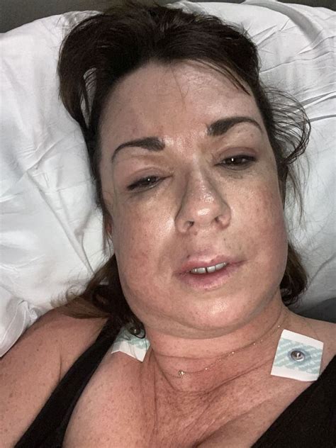 Mum Gets Lip Filler To Cheer Herself Up But Ends Up Almost Dying Wales Online