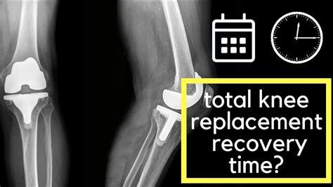 Recovery Time For Total Knee Replacement Youtube