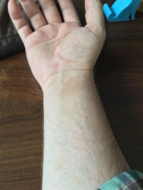 Everyone Gets These Wrist Bruises From Catching Right Ultimate