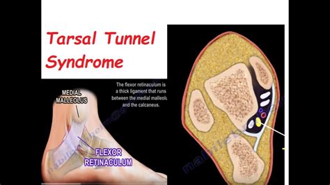 Tarsal Tunnel Syndrome —