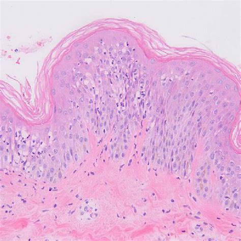 Subcorneal Neutrophilic Pustule And Edema As Well As Peripheral