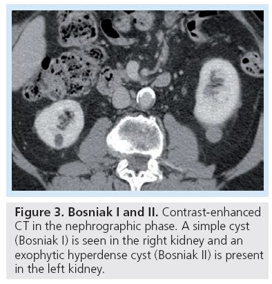 Renal failure results when the kidneys cannot remove the body's metabolic wastes or perform their regulatory functions. Advanced cross-sectional imaging techniques for the ...