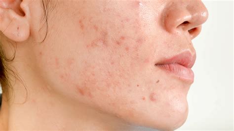 How To Get Rid Of Acne Scars Topical Treatments Surgery And More Goodrx