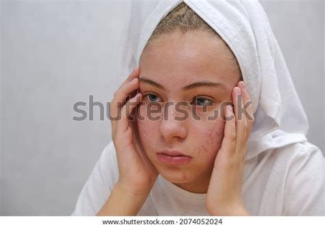 Acne Sad Teenage Girl Problematic Skin Stock Photo 2074052024