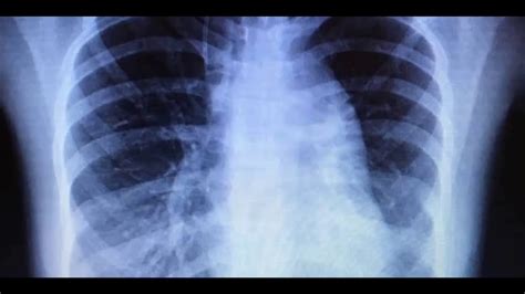 Edema Agudo Pulmonar Radiografia Image To U