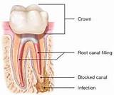 Images of Root Canal Treatment Procedure Pictures