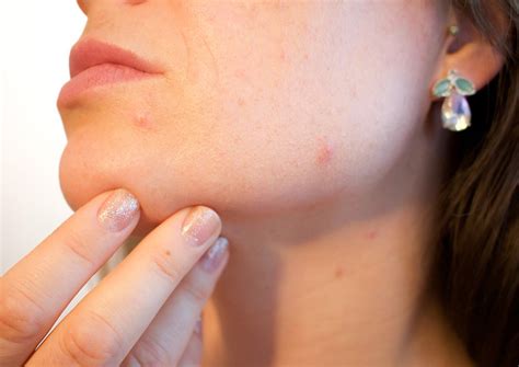 Share photos and videos, send messages and get updates. Never pop pimples on your face's 'danger triangle' - it ...