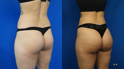 Brazilian Butt Lift Surgery Before And After Houston Tx Patch