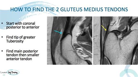 Gluteus Medius MRI
